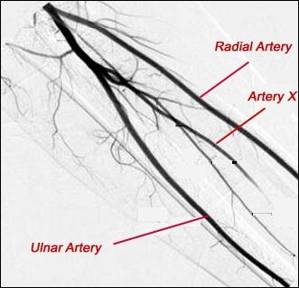 Quel est le nom de l'artère X (angiographie) à l'avant-bras ?
