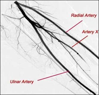 Quel est le nom de l'artre X (angiographie)  l'avant-bras ?