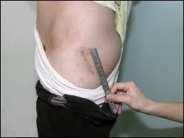 Coxarthrose, femme de 57 ans, trs branche, elle pose la question trs mdiatise depuis 10 ans de la prothse totale de hanche (PTH) par 'mini incision' avec navigation (2003). UNE CHOSE EST SURE ?