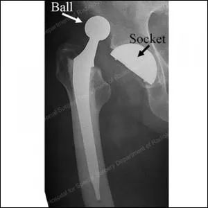 Quelle est LA voie d'abord de la hanche pour pose de PTH qui assurerait le taux le plus faible de luxation ?