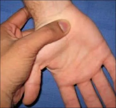 Mme avec un examen lectrique normal ou absent, tous les signes suivants, si groups par 4, sont trs en faveur d'un 'canal carpien', SAUF UN. Lequel ?