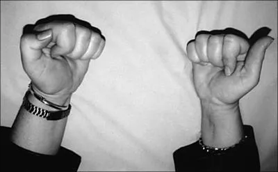 1 mois aprs un diagnostic de syndrome nvrite brachiale (Parsonage-Turner), sans aucun trouble de la sensibilit, le poignet reste difficile  bien fermer (image). Diagnostic et traitement ?