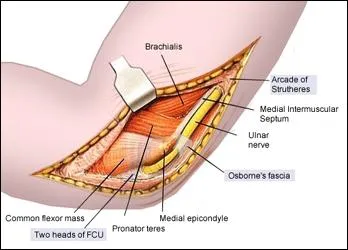 Tous les lments anatomiques suivants sont des siges possibles de compression du nerf cubital et de ses vaisseaux, SAUF UN. Lequel ?