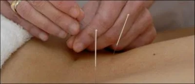 C'est une mdecine reposante et regnratrice invente dans ce pays. On s'aide d'aiguilles pour stimuler les zones sensibles. Quelle est cette pratique ?