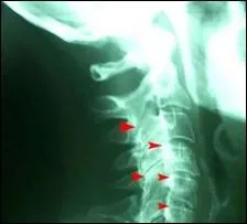 Quel est le nombre de vertbres cervicales ?