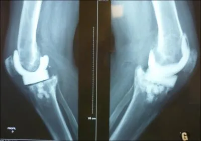 Chez cette sexagnaire amricaine, aux genoux douloureux et gonfls depuis 3 mois, avec Staph dor  la ponction, le recours  un espaceur dans les DEUX genoux simultanment est suivi de :