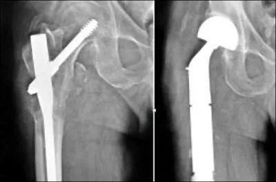Homme de 75 ans (radios), fracture de fmur sur mtastase de cancer du rein, fix et irradi, 2 ans avant. Quel est le risque de la pose de la grande PTH (images) ?