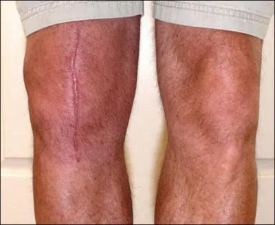 4 mois aprs la pose de PTG, sans antibiotiques, ni immundpresseurs, ce diabtique de 67 ans, se plaint de son genou. CRP et VS sont  22 et 13. Dans le genou, leucocytes  1600 et PN 30%. Conduite ?