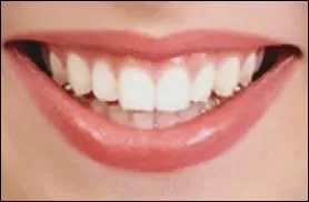 Dents : le mot se traduit par :