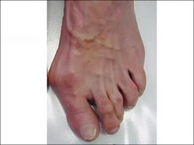 'Oignons' aux 2 pieds, chez une femme ge de 67 ans. Tous les gestes chirurgicaux suivants, exposent  la 'rcidive', SAUF UN :