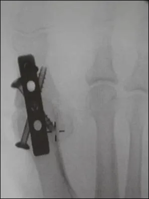 57 ans, femme opre d'hallux rigidus (gros orteil raide pour les hellno-latinistes... ) avec un AN plus tard durillon pnible sous la tte de m2. Geste omis lors de l'opration ?