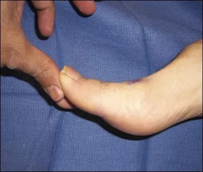 45 ans, ouvrier du btiment, gros orteil douloureux en extension passive (photo), sur les radios (centres mp1) arthrose mp1 trs discrte et 'bec de perroquet' dorsal, chec semelle. Opration ?