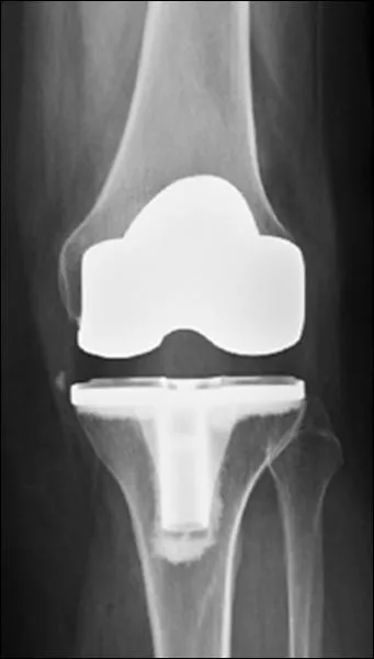 Femme, 65 ans, tats-unienne, retour de douleurs croissantes  7 mois de l'opration aprs progrs trs bons jusqu' 5 mois. Genou stable avec flexion 0-115. Prescription ?