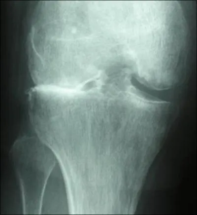 Parmi les patients suivants, LEQUEL ne prsenterait pas de contre-indication (thorique, relative ou absolue)  la pose d'une prothse totale de genou, conservant le ligament crois postrieur ? )