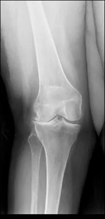 Homme 55 ans, 'programm' pour une prothse de genou (totale ou uni. ). Radio. Un seul des facteurs de suivants N'exposerait PAS  l'ossification ectopique (rarement gnante au genou). LEQUEL ?