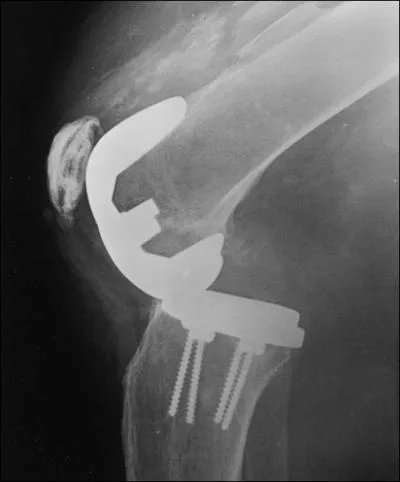 Cas malheureusement banal d'une femme de 66 ans au genou proths instable aprs pose d'une prothse conservant le ligament crois postrieur. Radios. Mcanisme le plus probable de l'instabilit ?