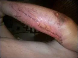 Comment appelle-t-on une 'couture' dans le jargon mdical ?