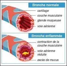 Atteint de bronchite chronique, je consulte un mdecin ...