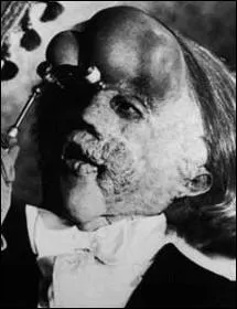 (Elephant Man) Ce film est tir d'une histoire vraie.