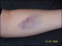 Voici un beau 'bleu', quel est son nom mdical ?