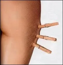 Pourquoi les femmes, et non les hommes, sont susceptibles de dvelopper la fameuse Culotte de cheval ?