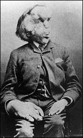 Joseph Merrick ( Elephant Man) tait lui considr comme une bte de...