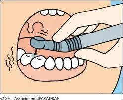Quelle est cette chose que le dentiste nous met dans la bouche ?