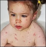 Quelle est cette maladie qu'a attrap le petit garon ?