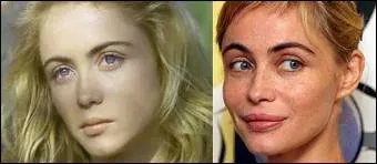 Emmanuelle Bart vient de faire une interview dans laquelle elle dit regretter quelle chirurgie esthtique ?