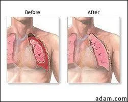 Compltez. La prsence d'air dans la cavit pleurale (plvres, cf. Q1) constitue ...