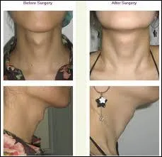 La pomme d'Adam, plus prominente chez l'homme que chez la femme, protge un organe. Lequel ?