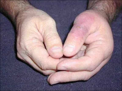 Avec quoi vous blesse une araigne ?