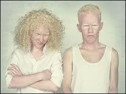 Un enfant n avec une couleur de peau trs claire, des cheveux blancs, des yeux roses tirant sur le violet est atteint d'une anomalie gntique appele :