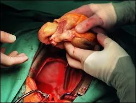 En quelle anne le chirurgien sud-africain Christiaan Barnard russit-il la premire transplantation cardiaque ?