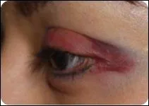 Si vous vous cognez, vous aurez un ''bleu'' mais le médecin parlera plutôt d'...