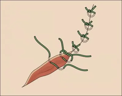 Biologie : Quel mot dsigne une couture chirurgicale des lvres d'une plaie ?