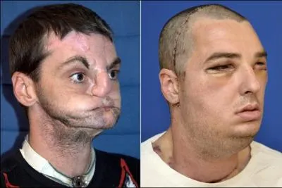 Nouveau visage pour Richard Norris cet Amricain mutil ; que lui tait il arriv ?