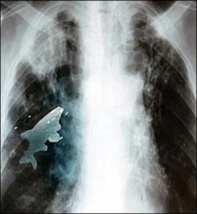 En Inde , un enfant avale un petit poisson !