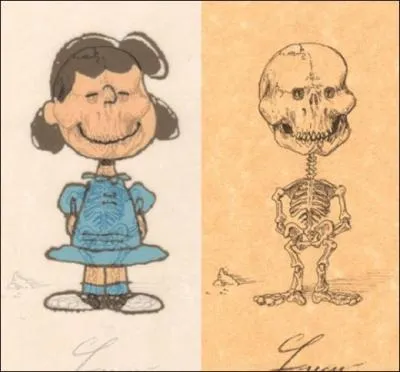 Quel musicien clbre est dcd suite  la maladie des os de verre ?