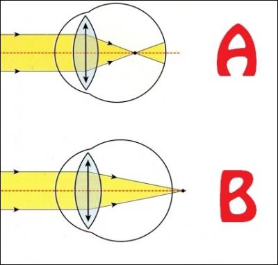 Quel schma reprsente un il dont le dfaut de vision est la myopie ?