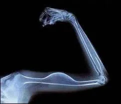 Léon Gambetta aurait pu passer une radiographie.