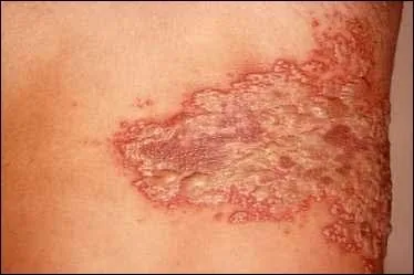 Le terme  ceinture de feu  dsigne galement une maladie cutane trs douloureuse. Sous quel autre nom cette maladie est-elle plus connue ?