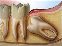 Troisime molaire, la dernire en arrire sur l'arcade dentaire, dont l'ruption se fait en gnral entre 16 et 25 ans, c'est :