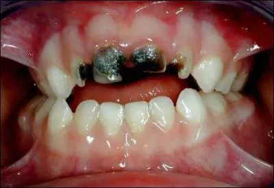 Maladie infectieuse de la dent qui est une lsion de l'mail et de la dentine, c'est :