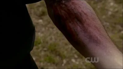 Comment gurit-on une morsure de loup-garou ?