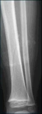 Les os se fragilisent aprs un alitement prolong.