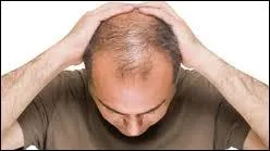 Pour certains, la calvitie, plus frquente chez les hommes que chez les femmes, serait due notamment aux hormones mles qui auraient une influence ngative sur la pousse des cheveux. Ont-ils raison ?