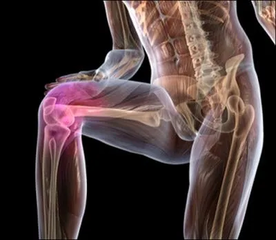 La sciatique, la cruralgie, se plaisent méchamment à parcourir les trajets nerveux. Elles entrent dans la catégorie des :