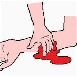 Lorsque l'hmorragie sige  l'extrmit d'un membre, l'lvation de celui-ci au-dessus du coeur peut contribuer  stopper l'hmorragie :