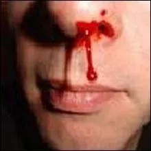 Une victime qui saigne du nez doit se le boucher elle-mme, la tte et le regard vers le haut :